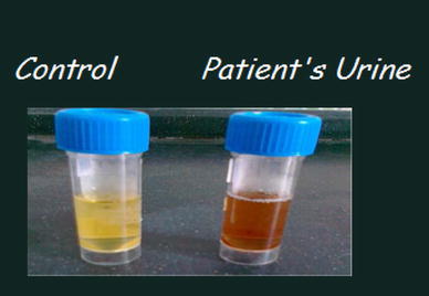 myoglobinuria hemoglobinuria fig urine differentiate primary