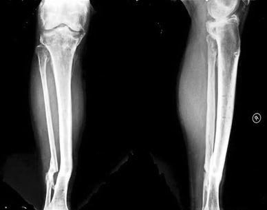 Anterior knee dislocation with ipsilateral open tibial shaft fracture ...