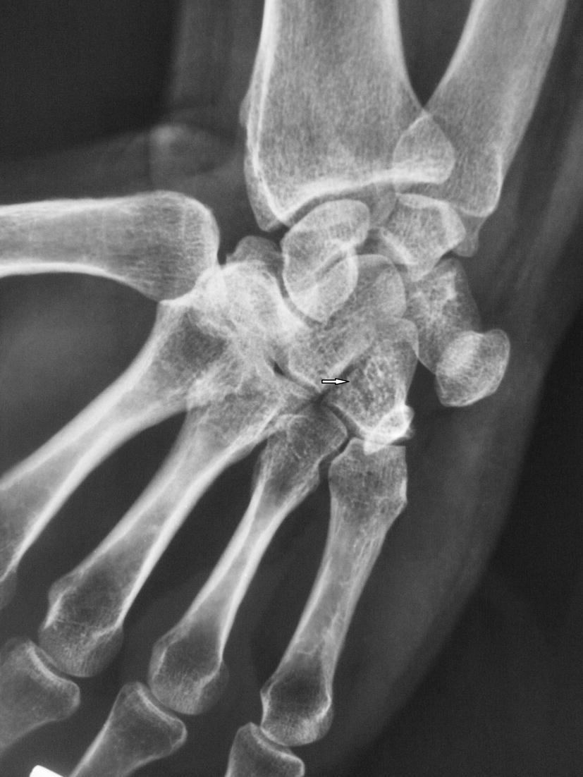 Fractures of hamate a clinical overview SpringerLink