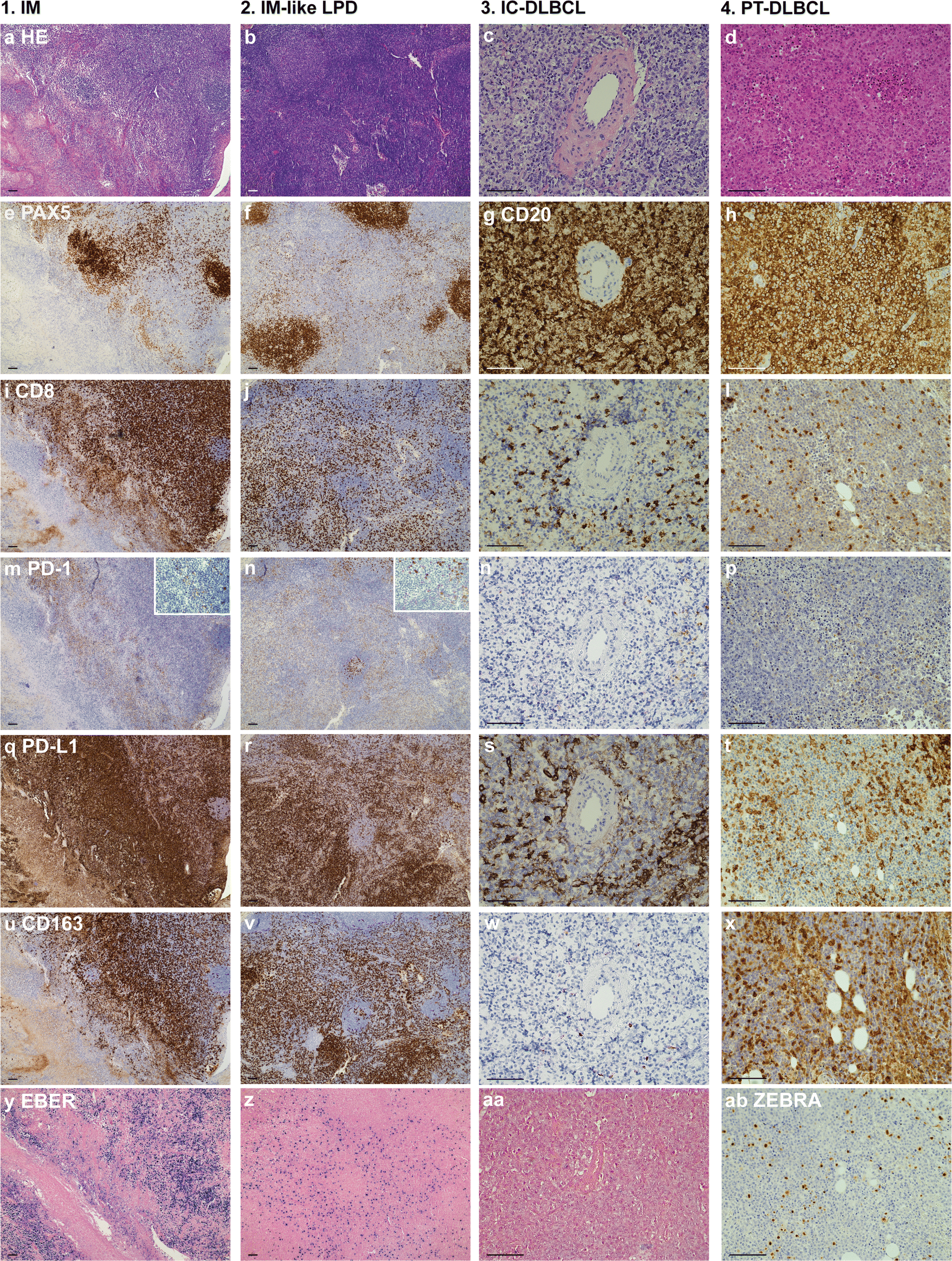 The Tumor Microenvironment In Post Transplant Lymphoproliferative Open Image In New Window
