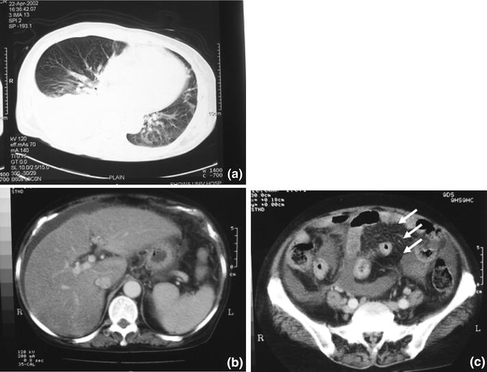 blood t-bil test peritonitis Two with cirrhosis tuberculous cases liver of