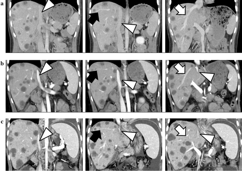 A case of severe stenosis of hepatic veins and inferior vena cava with