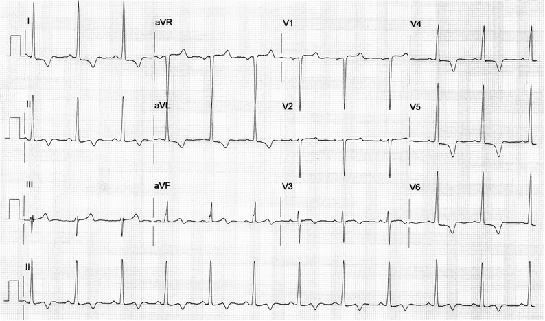 Myocardial perfusion image findings in apical hypertrophic ...