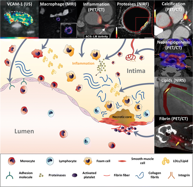 Vulnerable Plaque Molecular Imaging Springerlink - 