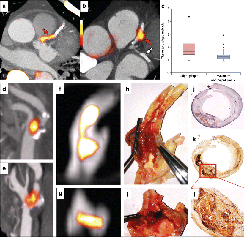 Vulnerable Plaque Molecular Imaging Springerlink - 