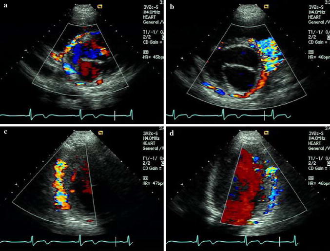 BlandWhiteGarland syndrome SpringerLink