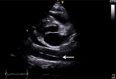 Point-of-care echocardiography for aortic dissection, pulmonary ...