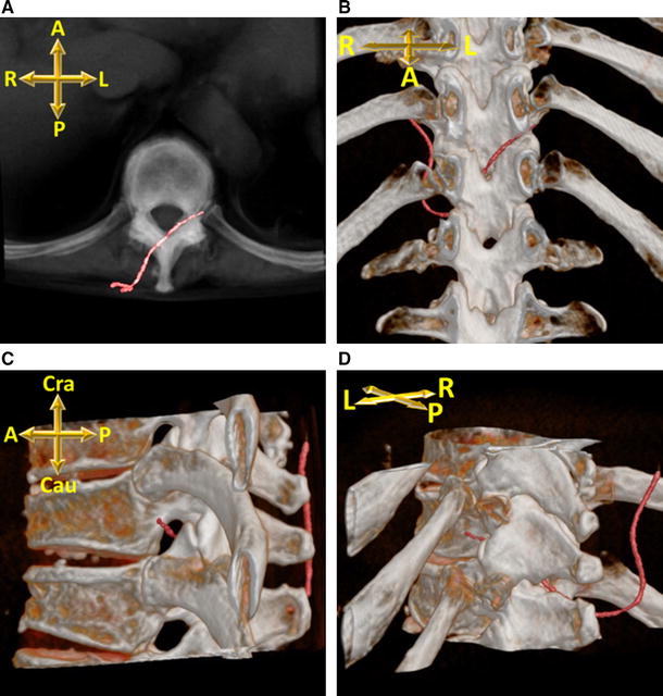 Transforaminal migration of an epidural catheter SpringerLink