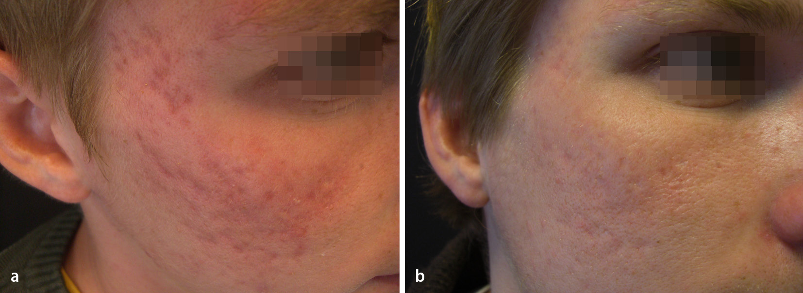 Microneedling zur Narben und Kollageninduktionstherapie SpringerLink