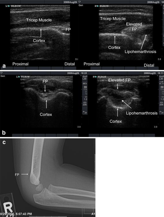 Rapid screening for the posterior fat pad sign in suspected pediatric