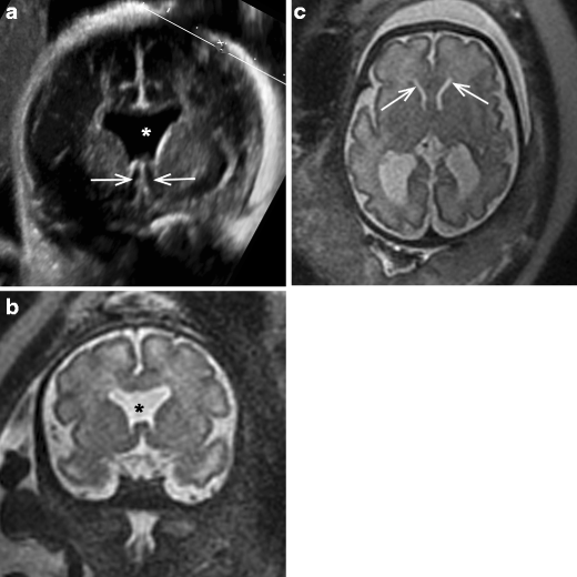 Non Visualisation Of Cavum Septi Pellucidi Implication In