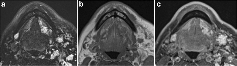 Imaging Of The Sublingual And Submandibular Spaces