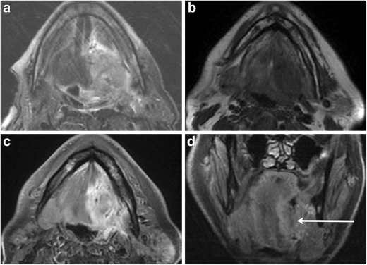 Imaging Of The Sublingual And Submandibular Spaces