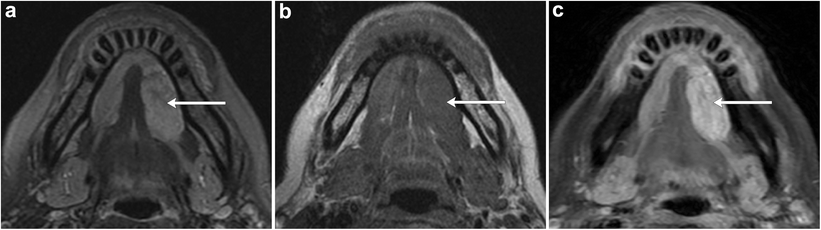 Imaging Of The Sublingual And Submandibular Spaces