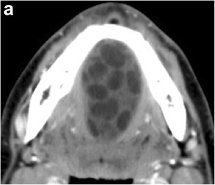 Imaging Of The Sublingual And Submandibular Spaces