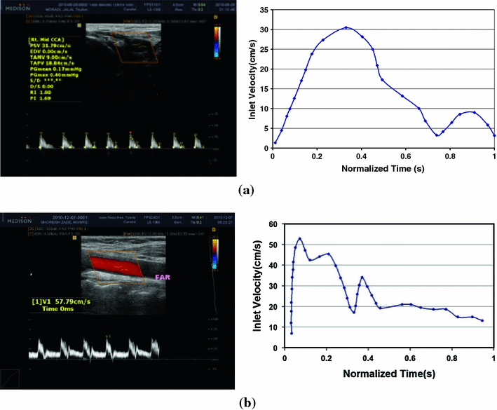 Carotid Ultrasound Velocity Chart