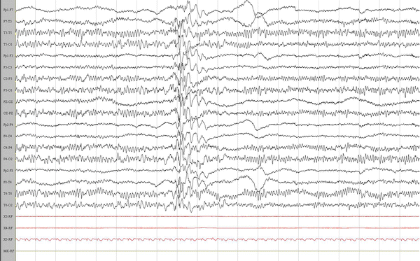 Resultado de imagen de paroxistic eeg in autism