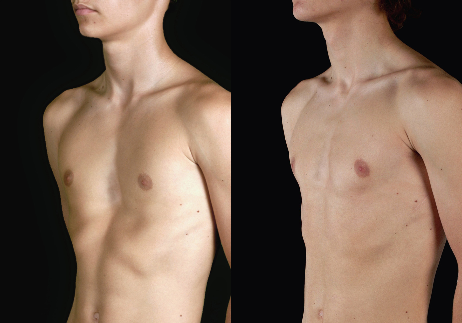 Minimalinvasive Korrektur der Trichterbrust SpringerLink