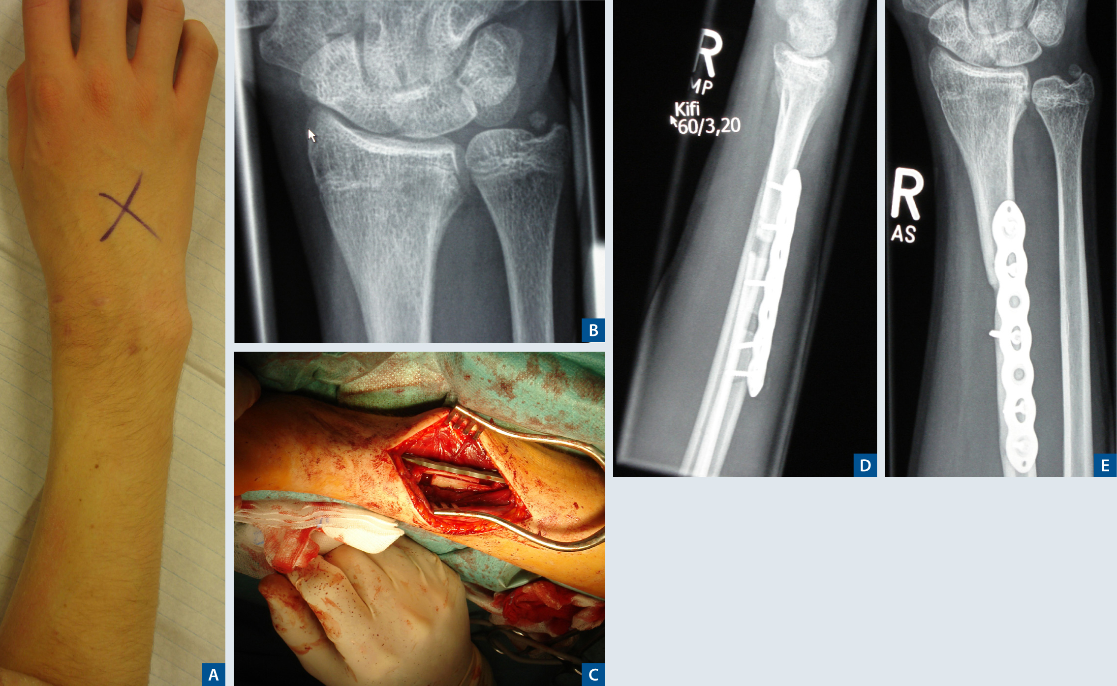 Korrekturosteotomien an Hand und Handgelenk SpringerLink