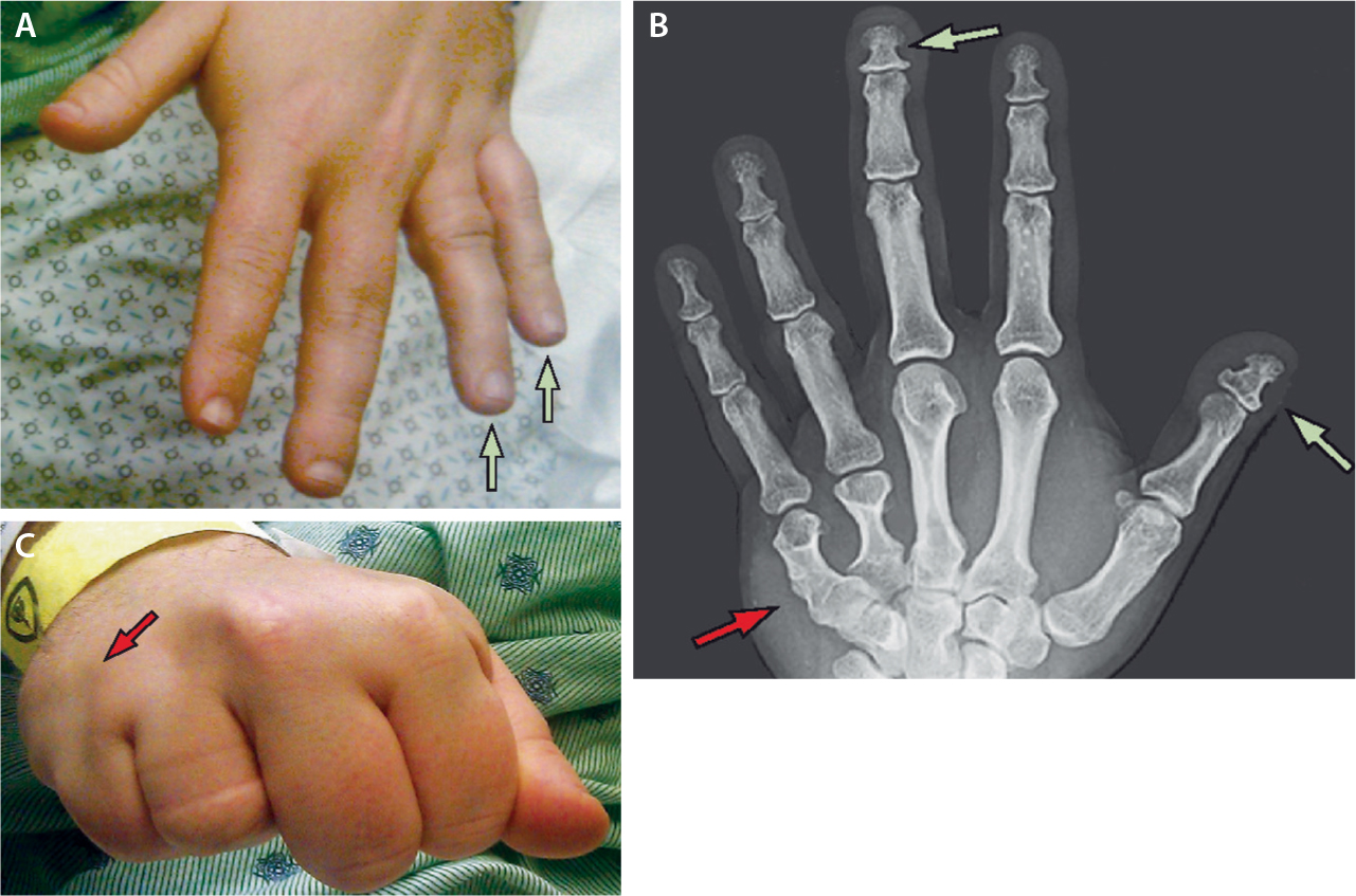 Pseudopseudohypoparathyreoidismus SpringerLink