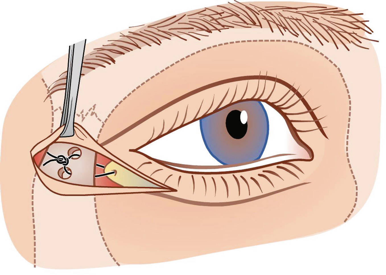 Fazialisparese — wenn die Mimik erlischt SpringerLink