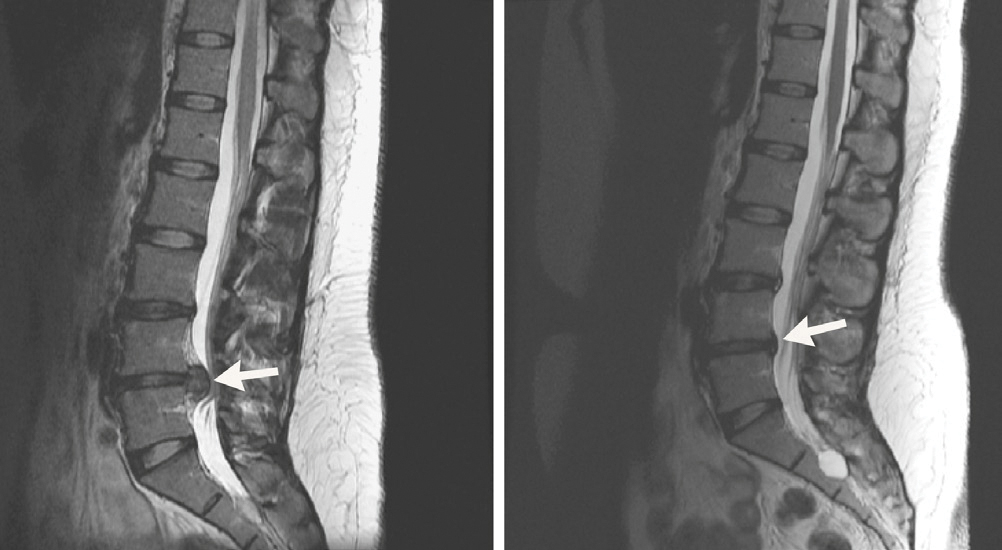 Wie sich ein Bandscheibenvorfall ohne Operation zurückbildet SpringerLink