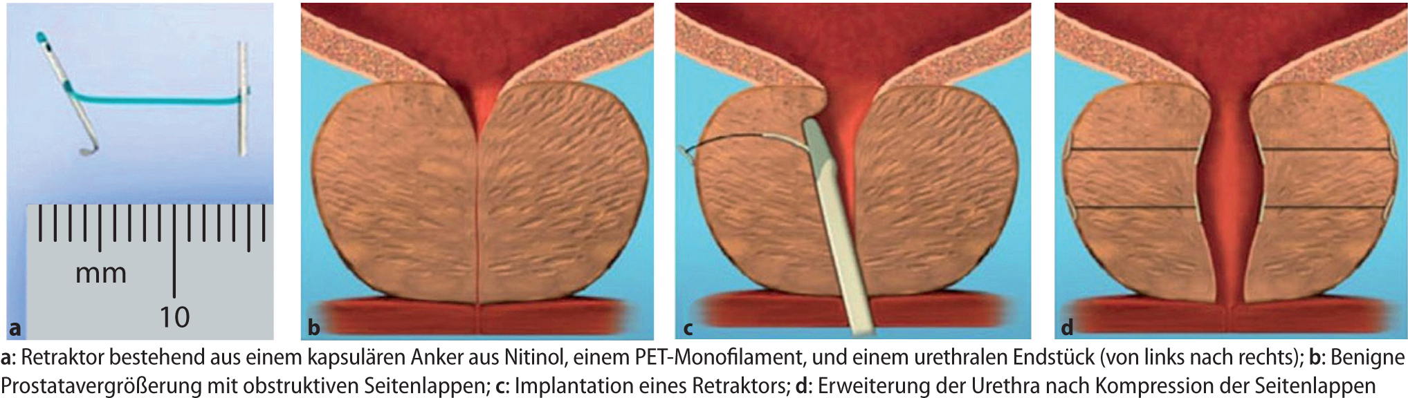 Management des benignen Prostatasyndroms SpringerLink