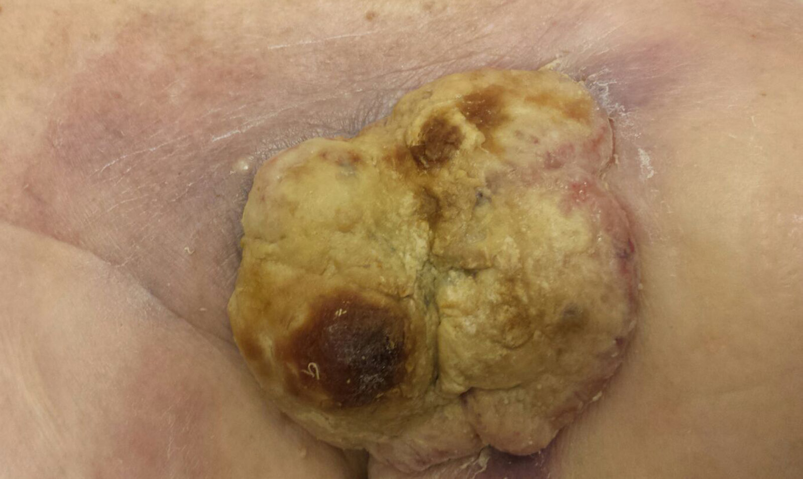 Blumenkohlartiger Tumor an der Brust SpringerLink