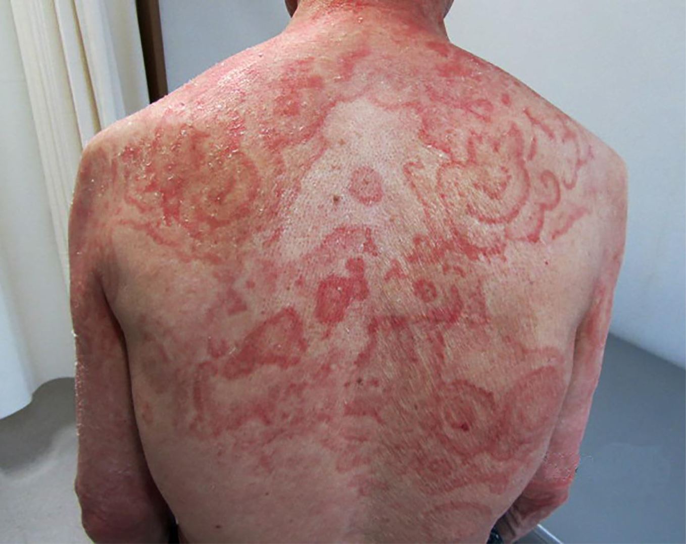 Erythema gyratum repens