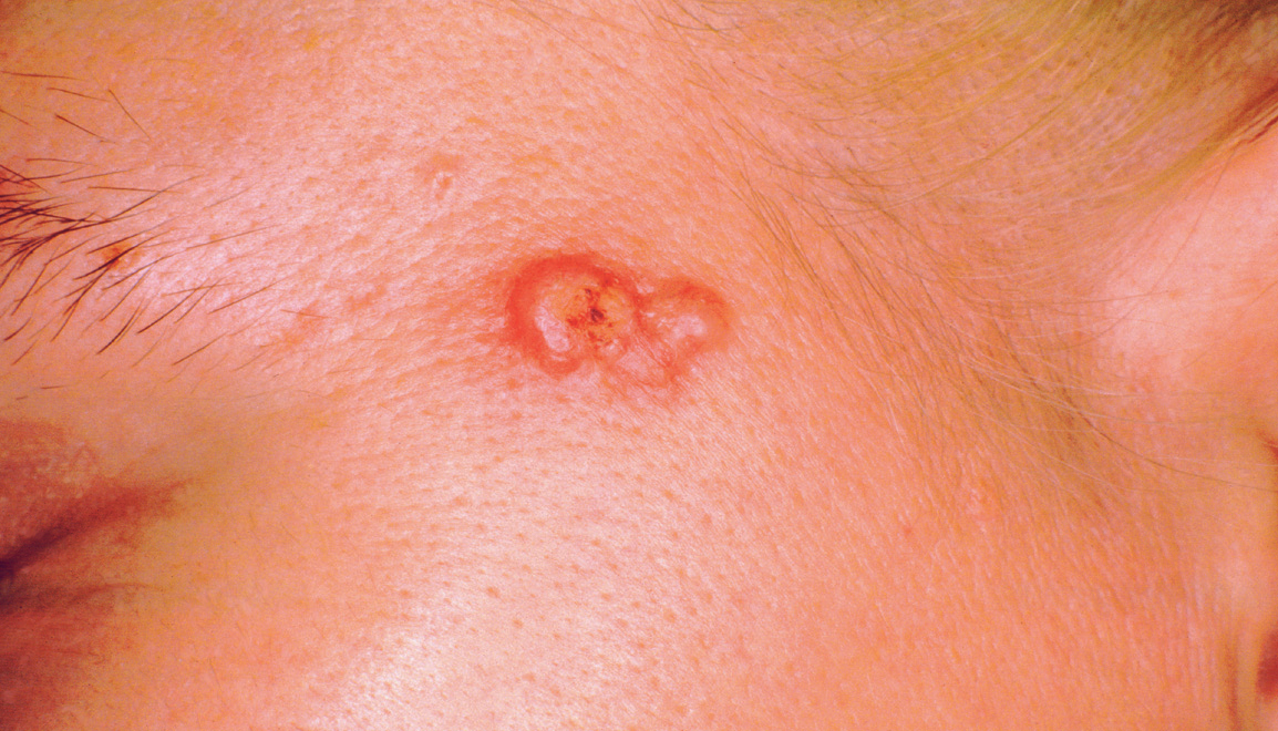 Das variable klinische Bild der Basalzellkarzinome SpringerLink Das variable klinische Bild der Basalzellkarzinome SpringerLink