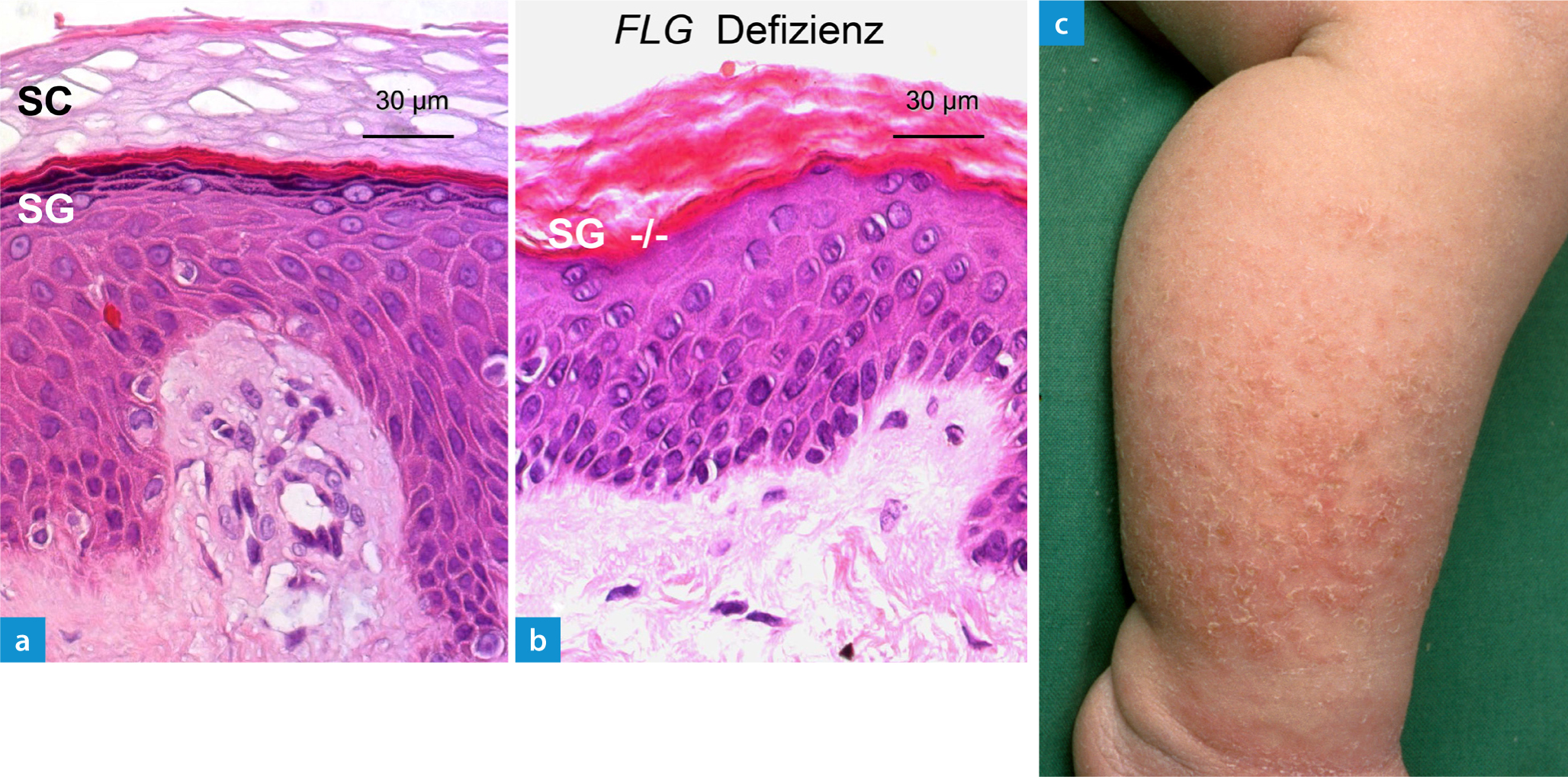 Ichthyosis vulgaris von Xchromosomal rezessiver Ichthyose