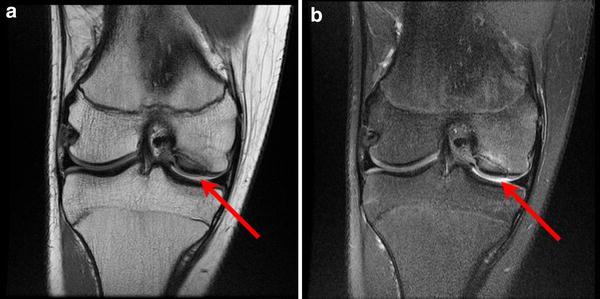 mri of sports injuries in children and adolescents whats mri of knee