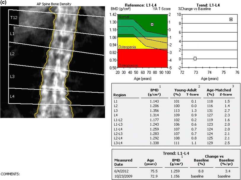 Bone Density Test Chart