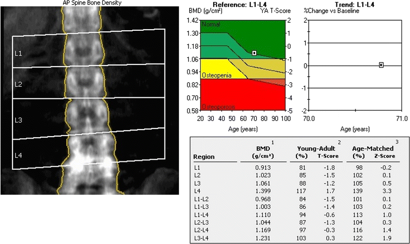 Bone Density Scan Results Chart