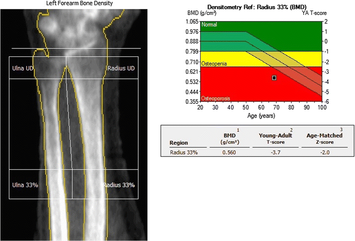 Bone Density T Score Chart