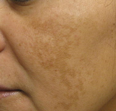 fig hyperpigmentation considerations facial treatment skin special