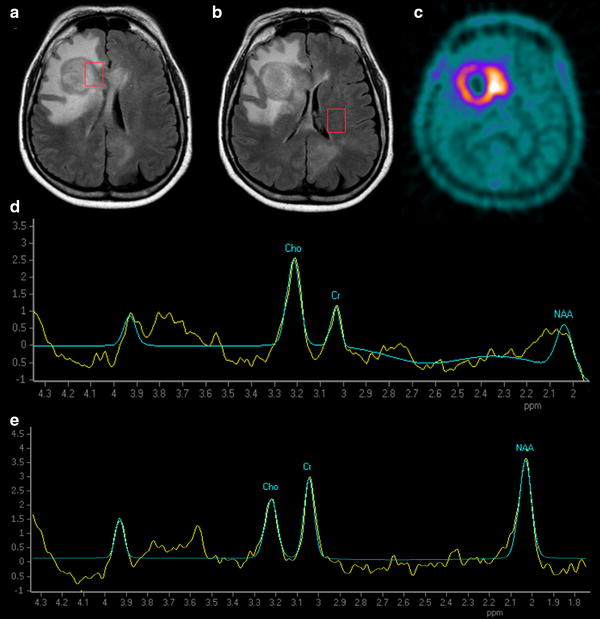 Positron emission tomography and resonance spectroscopy in