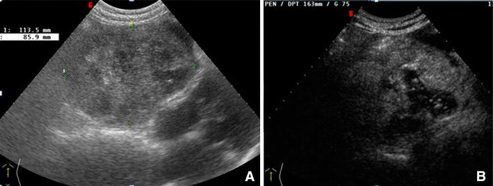 Acute Nontraumatic Liver Lesions Springerlink