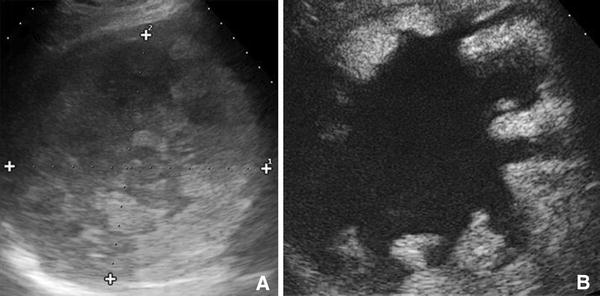 Acute Nontraumatic Liver Lesions Springerlink