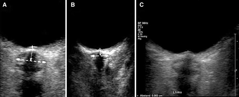 Sonography of the optic nerve sheath beyond the hyperacute stage of ...