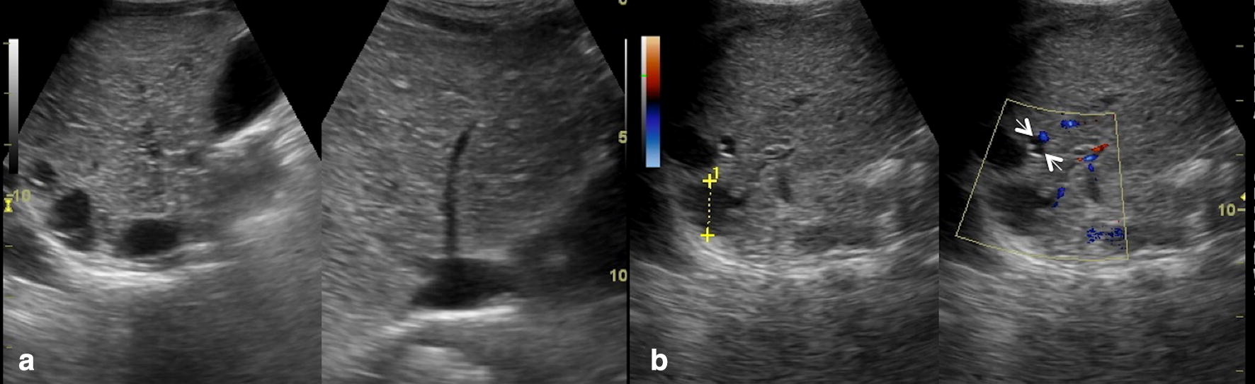 Ultrasound findings in paediatric cholestasis how to image the patient
