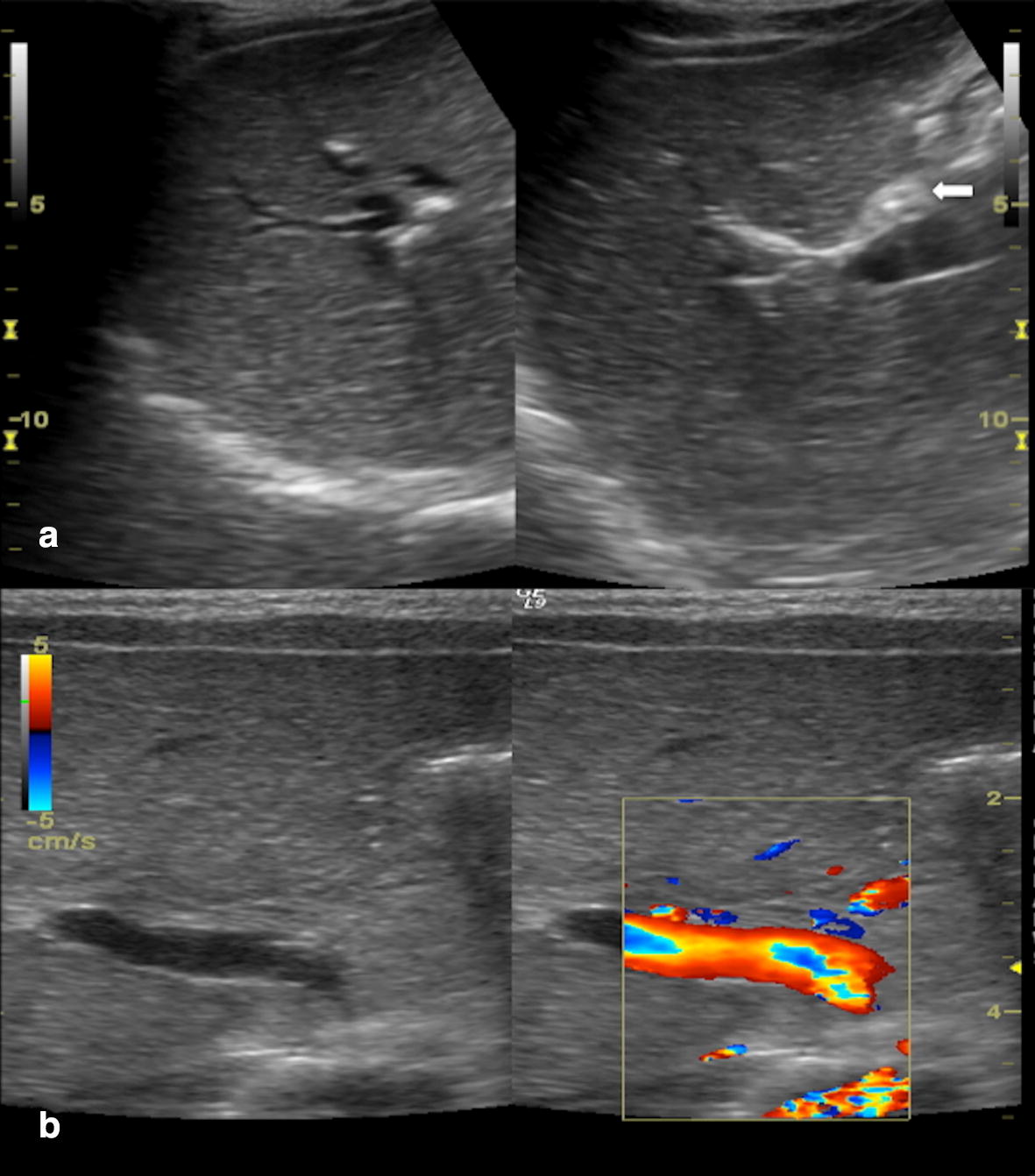 Ultrasound findings in paediatric cholestasis how to image the patient