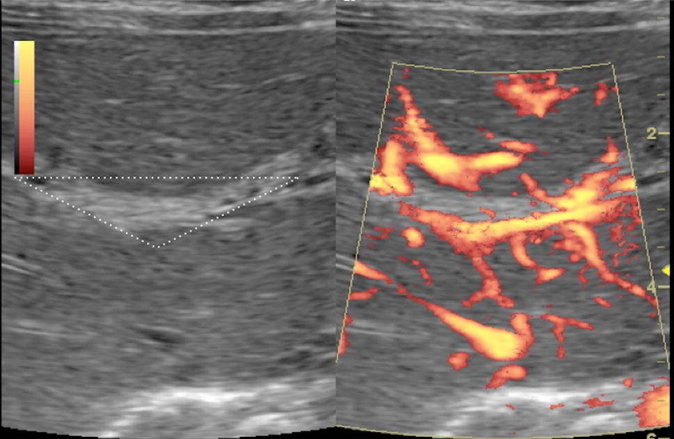 Ultrasound findings in paediatric cholestasis how to image the patient