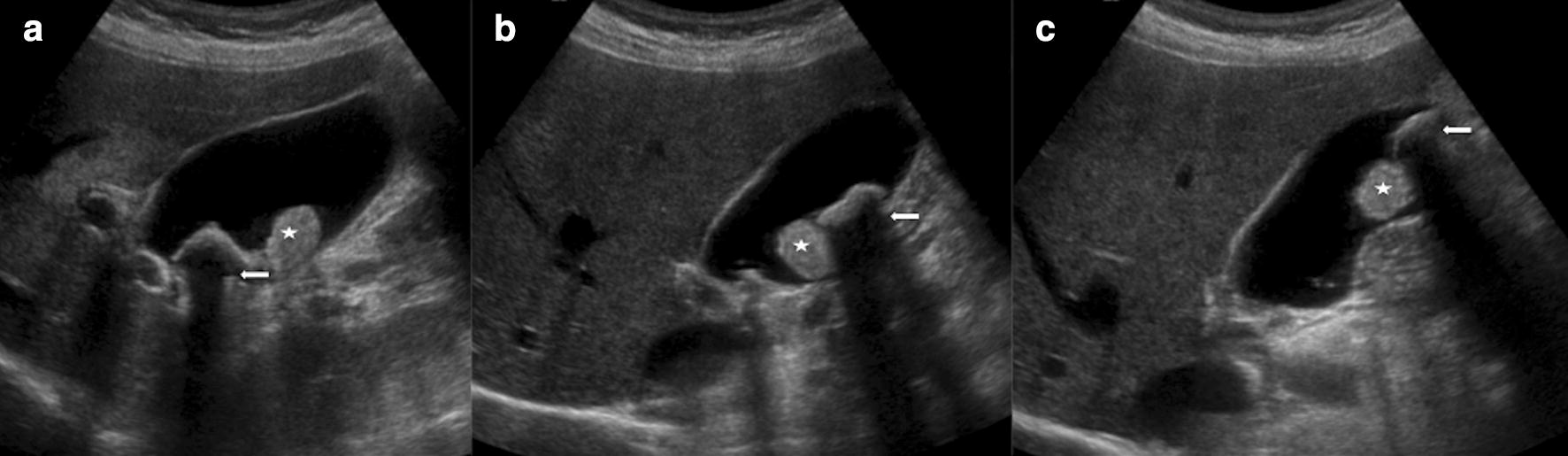 Ultrasound findings in paediatric cholestasis how to image the patient