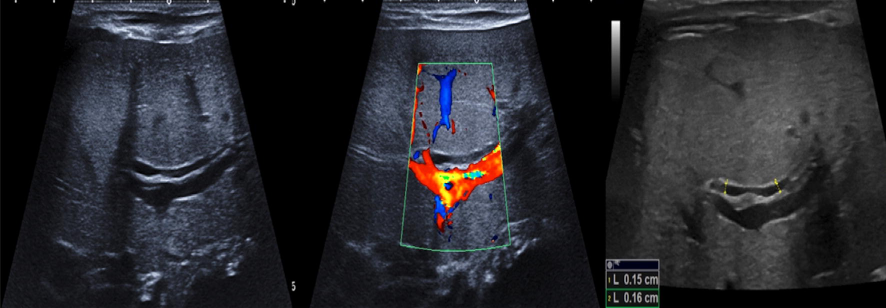 Ultrasound findings in paediatric cholestasis how to image the patient