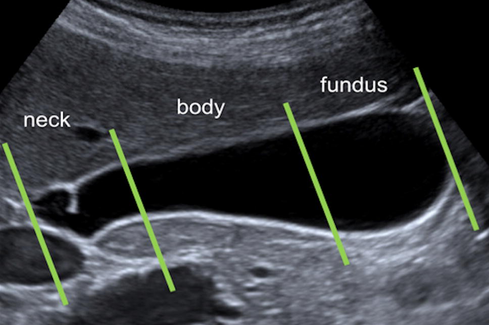 Ultrasound findings in paediatric cholestasis how to image the patient