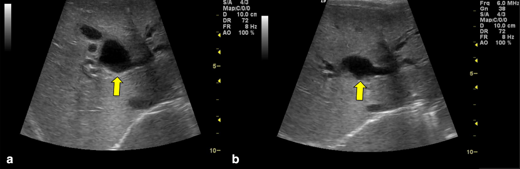 Ultrasound findings in paediatric cholestasis how to image the patient