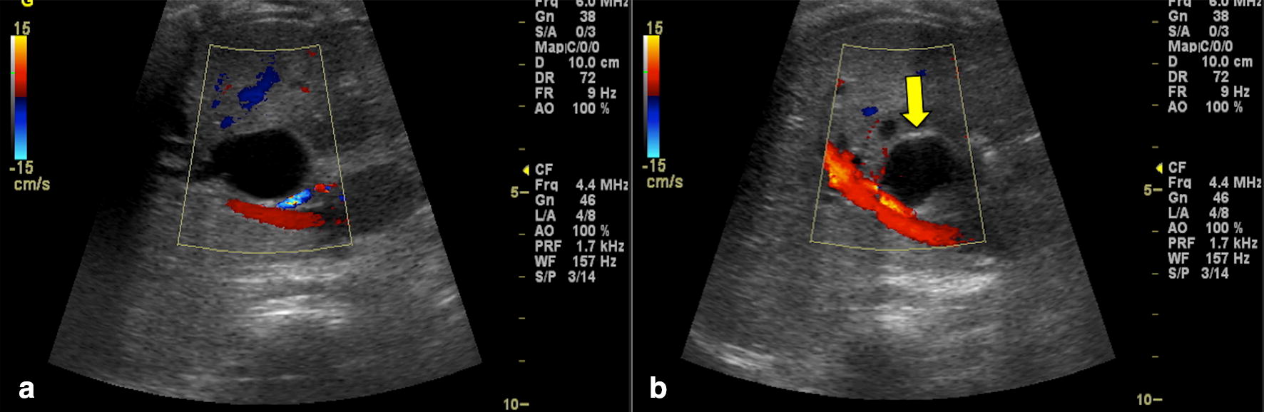 Ultrasound findings in paediatric cholestasis how to image the patient