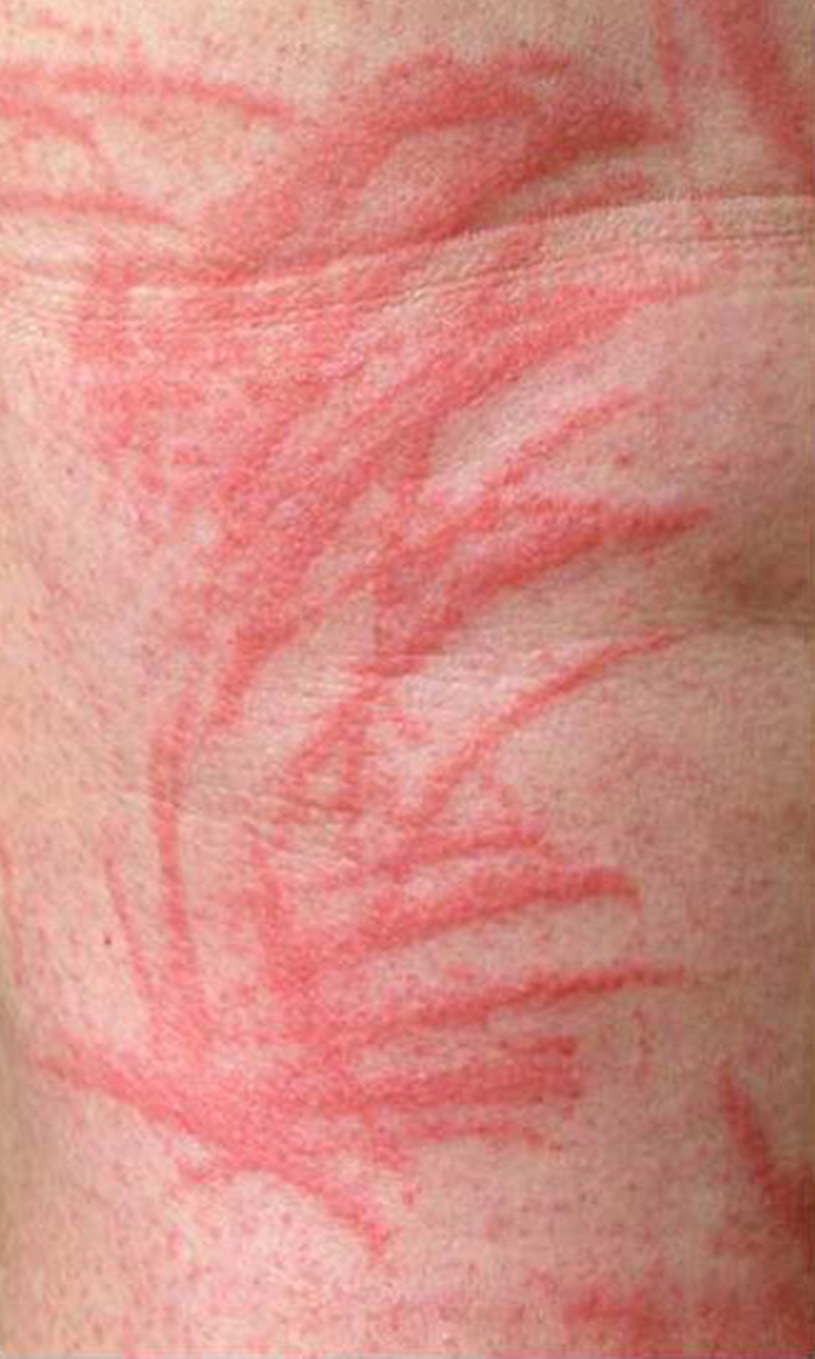 Eczema – in the focus between dermatology and allergology | SpringerLink