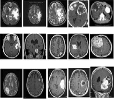 Benign Brain Tumor Size Chart